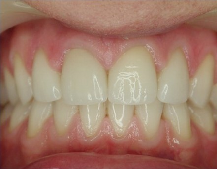 licówki porcelanowe dentysta łódź meritum