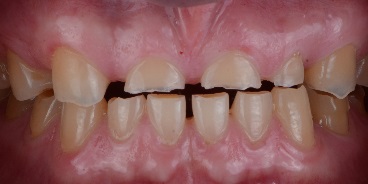 Dentysta Łódź starte zęby bruksizm