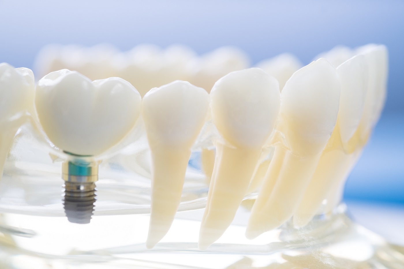 Leczenie kanałowe czy implanty zębowe?