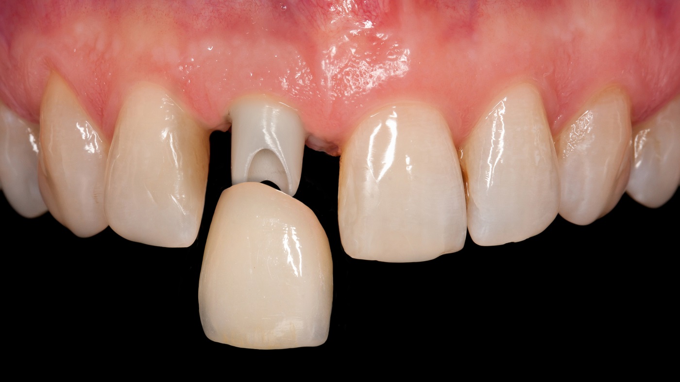 implanty zębów Łódź