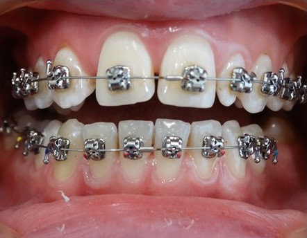 Brak zawiązków zębów stałych