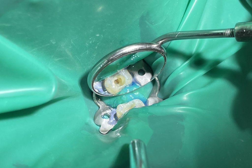 w lusterku stomatologicznym wnętrze zęba oglądane pod mikroskopem