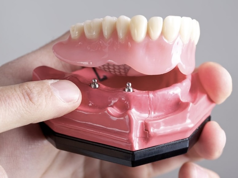proteza na implantach
