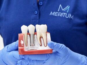 dentysta prezentuje implant zęba w trakcie konsultacji stomatologicznej