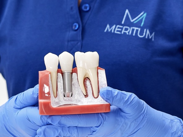 dentysta prezentuje implant zęba w trakcie konsultacji stomatologicznej