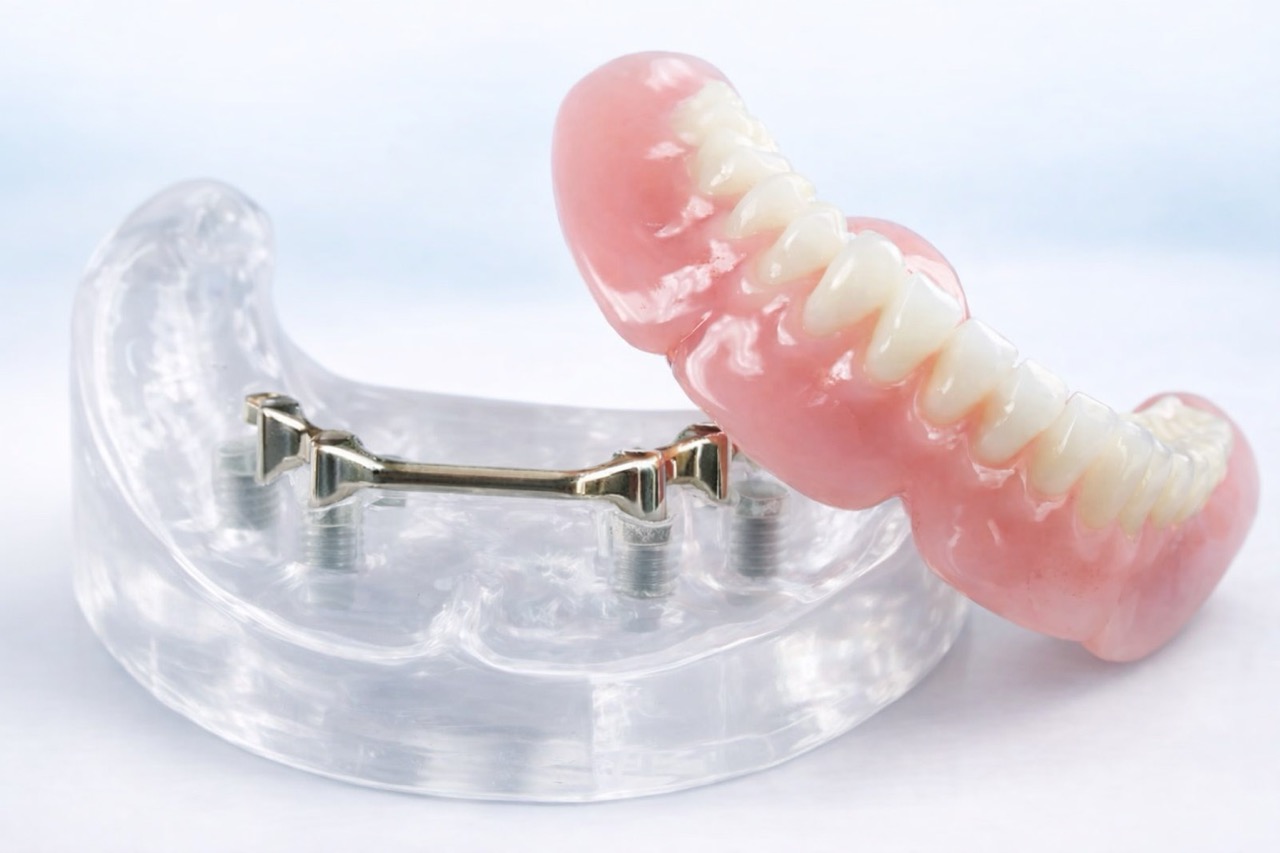proteza na implantach model z belką
stabilizującą overdenture Łódź