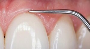 Ocena zdrowia dziąseł podczas konsultacji periodontologicznej