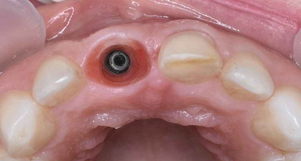 zdrowe dziąsło wokół implantu