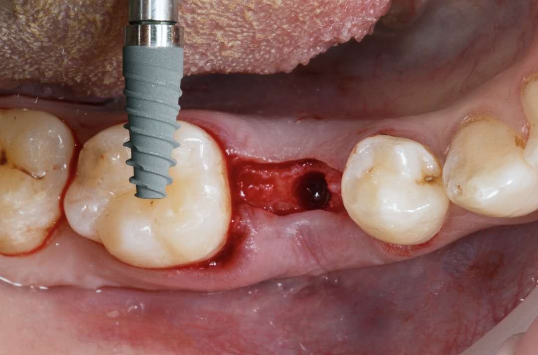 Implant po usunięciu zęba – planowanie leczenia implantologicznego
