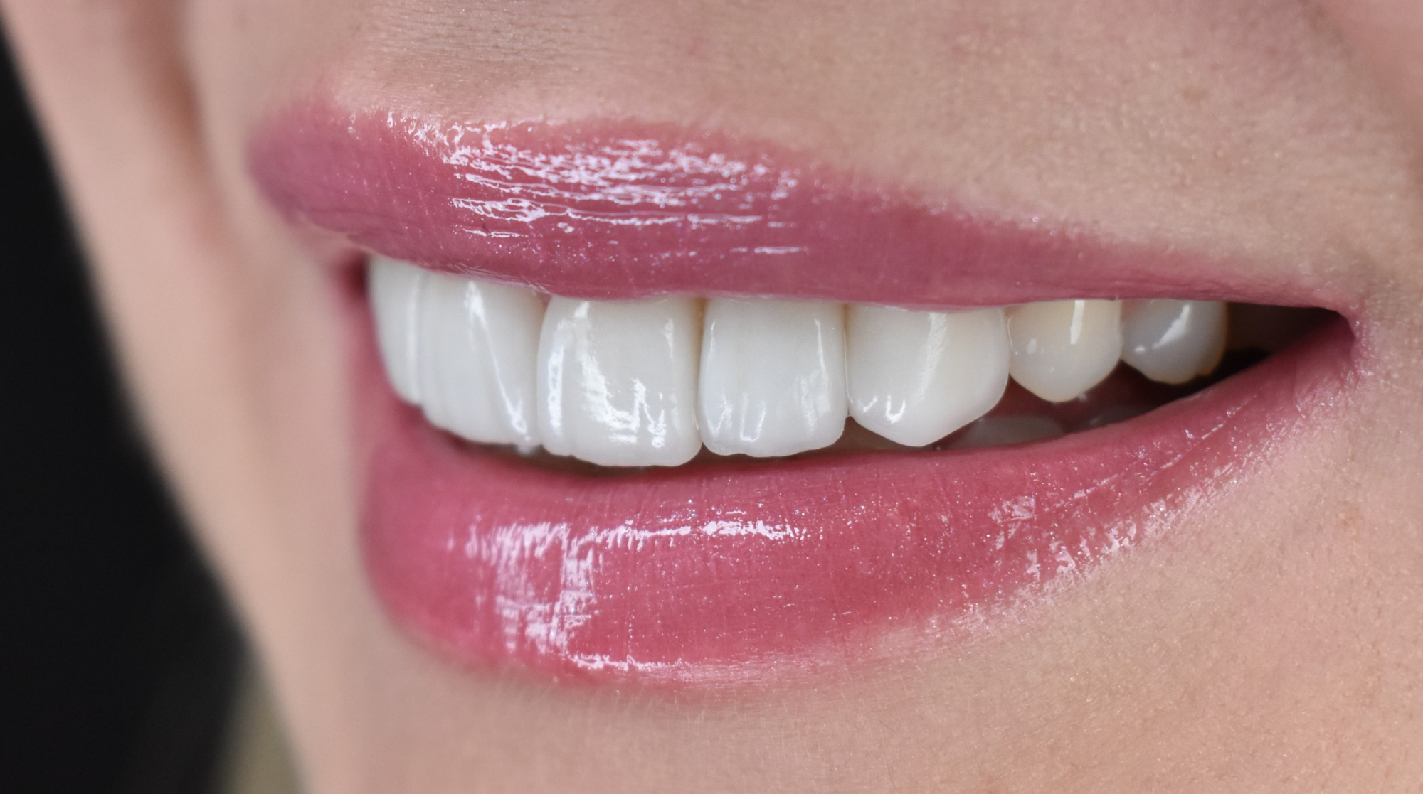 licówki porcelanowe efekt naturalnego białego uśmiechu stomatologia estetyczna Łódź