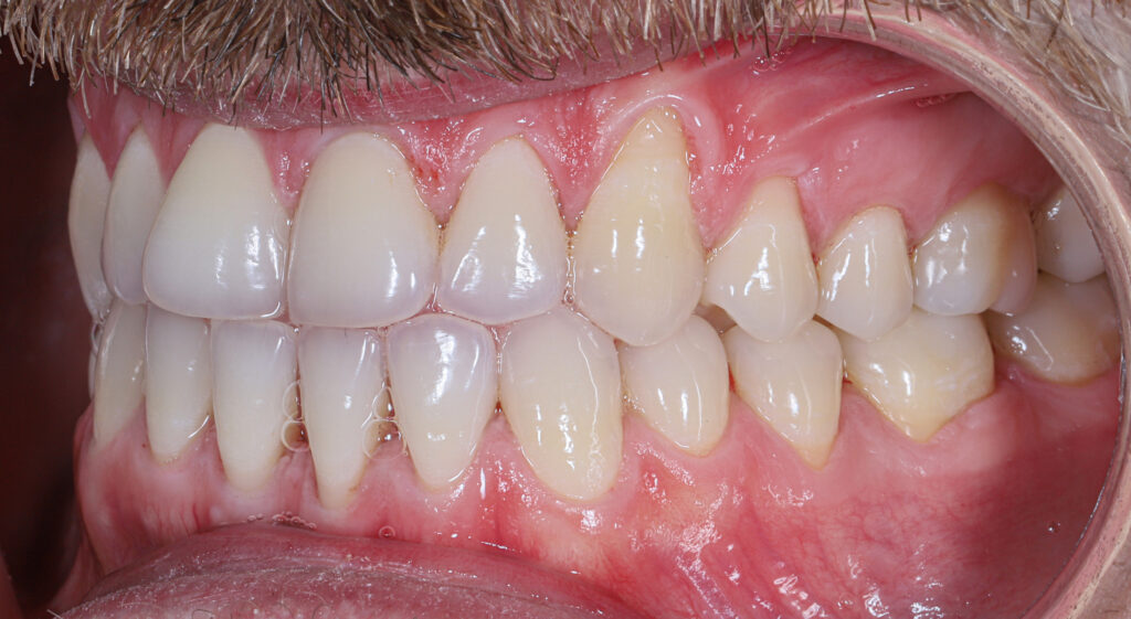 Ocena zdrowia dziąseł podczas badania periodontologicznego