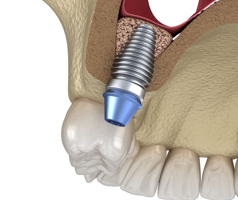 Model anatomiczny szczęki przedstawiający odbudowę kości lub podniesienie dna zatoki szczękowej.
