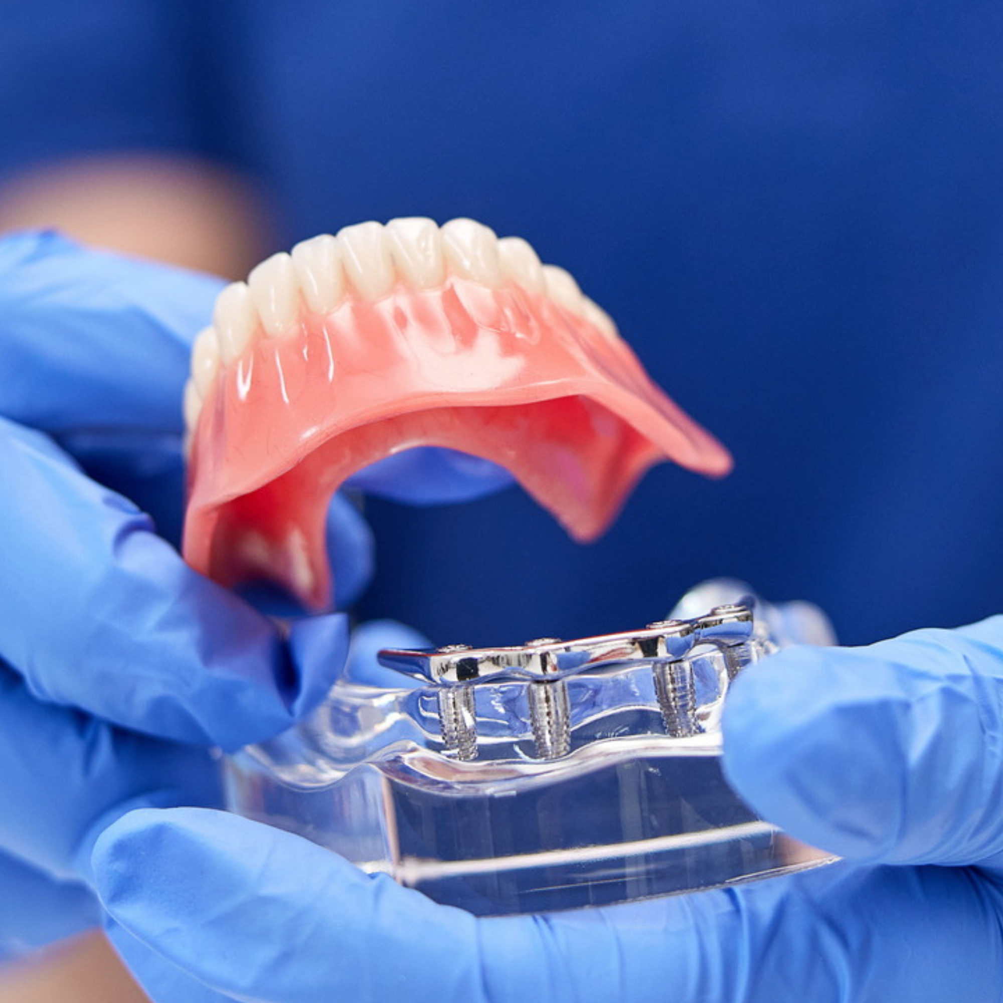 proteza na implantach model z belką stabilizującą overdenture Łódź
